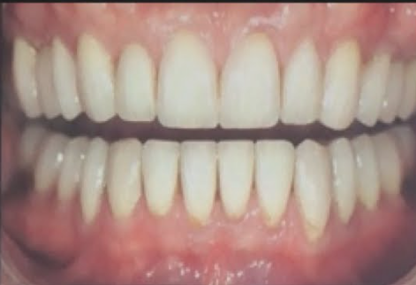 Full Mouth Rehabilitation after