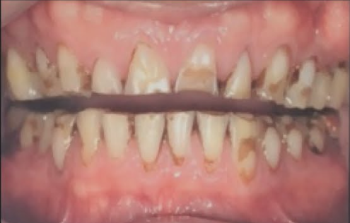 Full Mouth Rehabilitation before