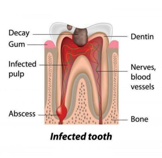 Root Canal + Crown before