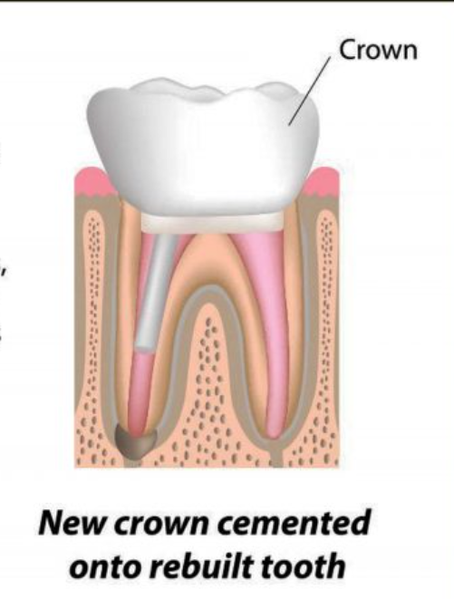 Root Canal + Crown after