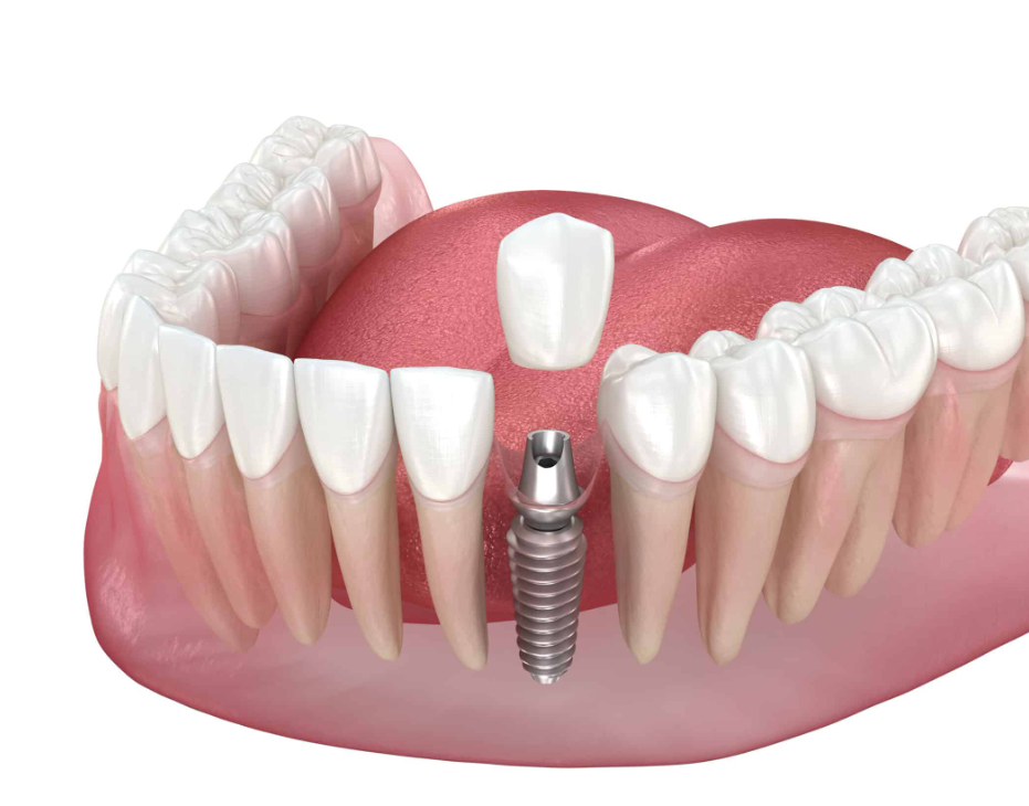 Single Tooth Implant after