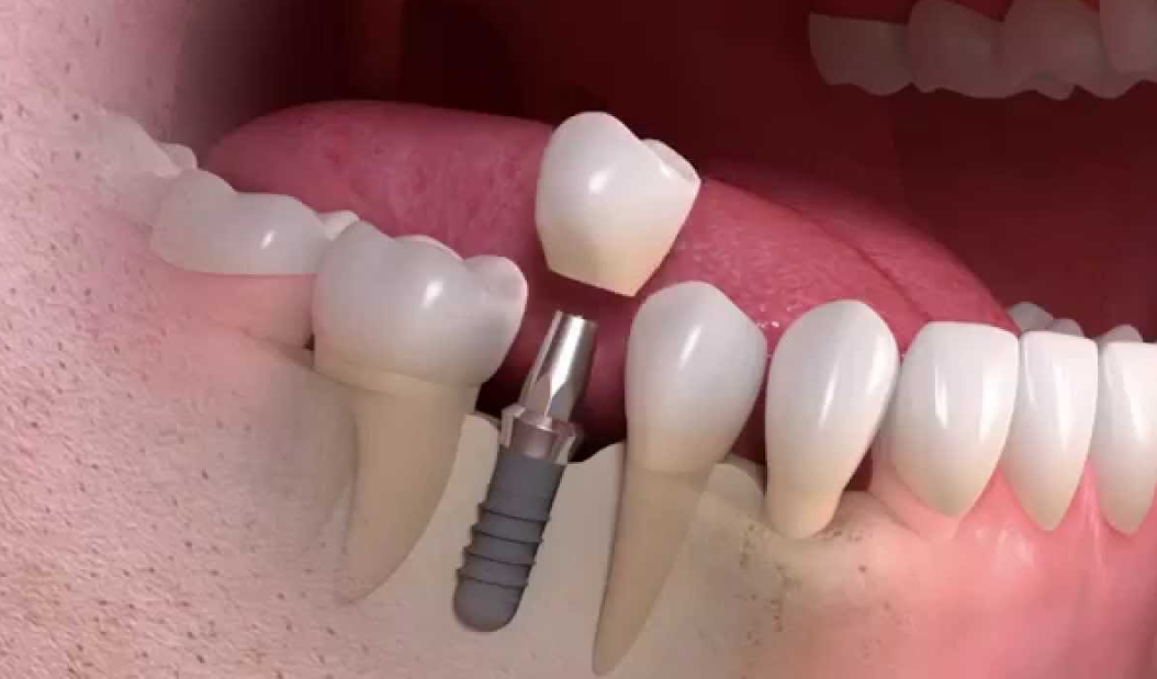 Single Tooth Implant before