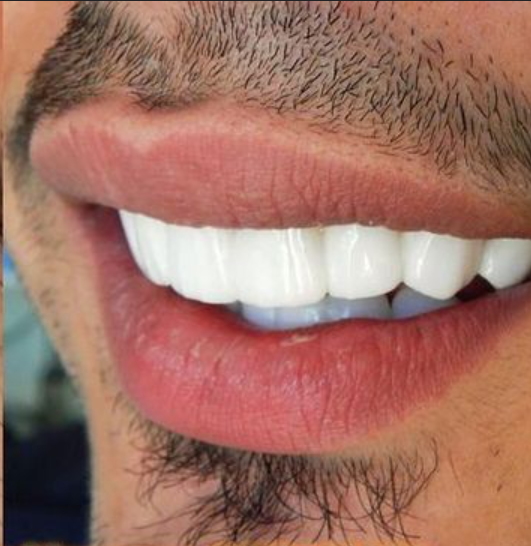 Complete Smile Makeover after