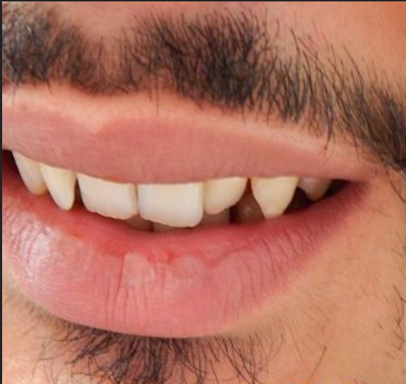 Complete Smile Makeover before