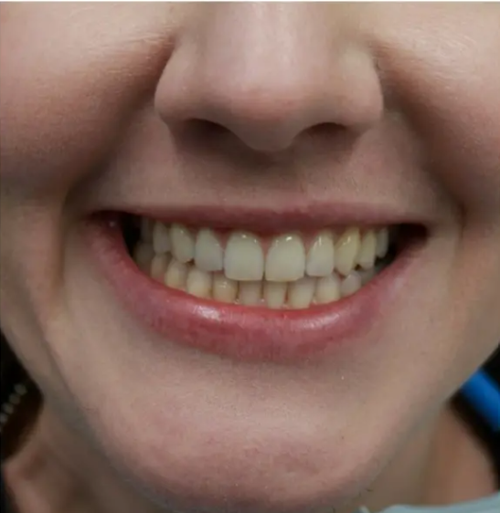 Teeth Alignment after