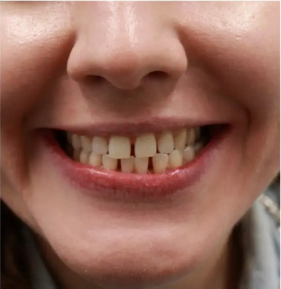 Teeth Alignment before